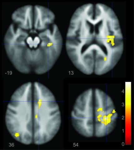 L'iimagine mostra le differenze nelle attivazioni cerebrali tra le performance buone e cattive 