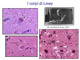 corpi di lewy